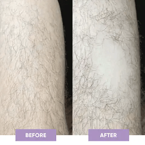 Magic Hair Eraser | Laser Removal At Home - Image 3